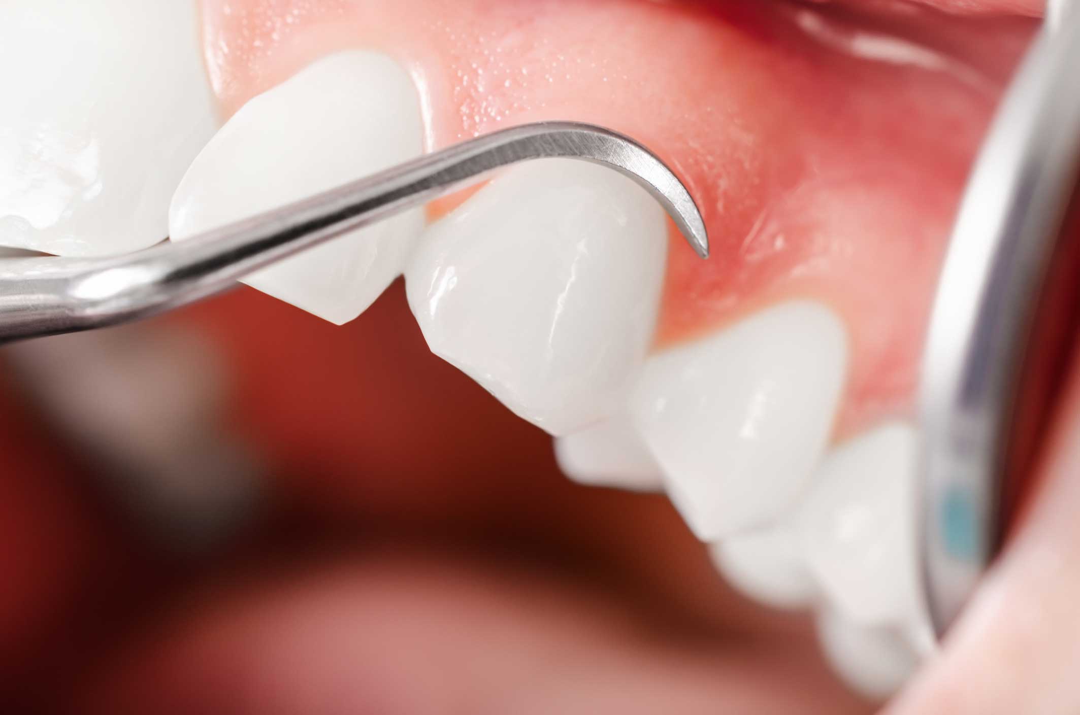 Periodoncia en Majadahonda, tratamiento para las encías en Majadahonda.