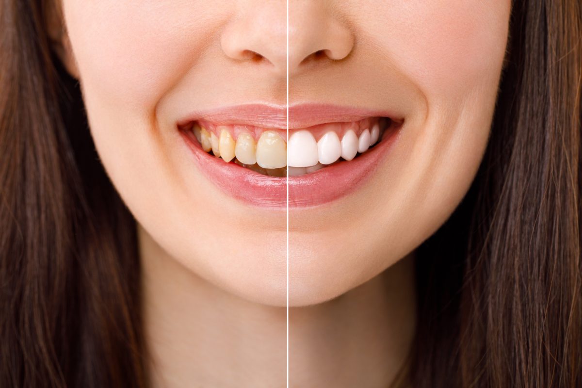 blanqueamiento dental en Majadahonda