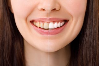 blanqueamiento dental en Majadahonda