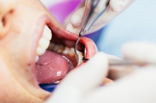 microabrasión dental