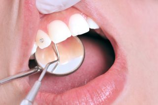 joyería dental