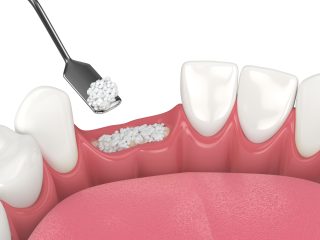 pérdida de hueso dental